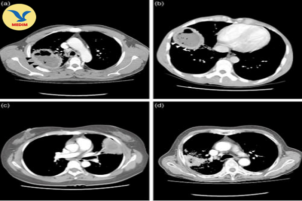 Vai trò của chẩn đoán hình ảnh trong chẩn đoán áp xe phổi